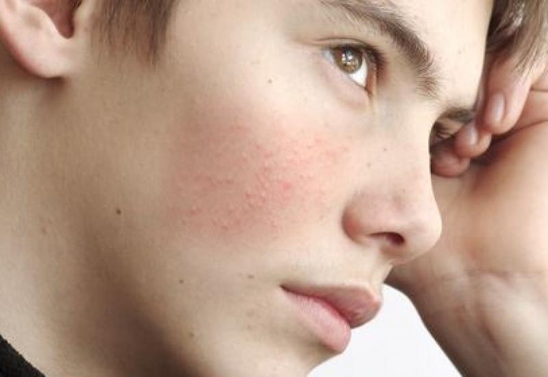 Consejos para tratar y aliviar el acné