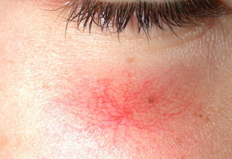 Recomendaciones SEFAC para prevenir y tratar la piel sensible con rojeces