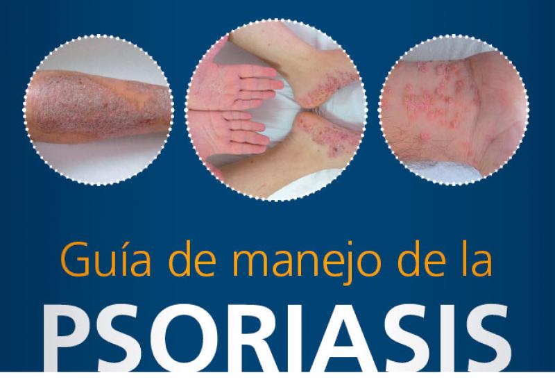 Guía de manejo de la Psoriasis en la Farmacia