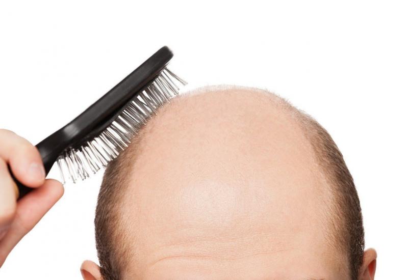 Consejos para la prevención de la alopecia